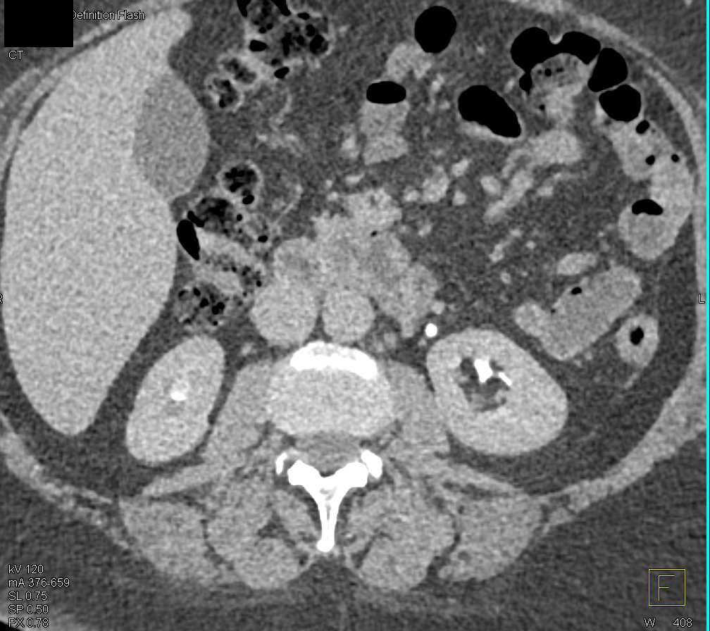 Stone in the Distal Left Ureter - CTisus CT Scan