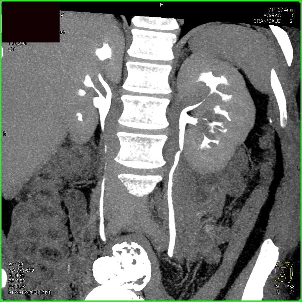 Stone in the Distal Left Ureter - CTisus CT Scan