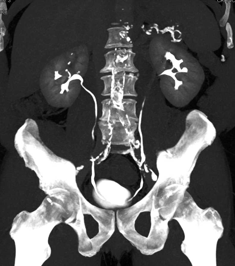 Transitional Cell Carcinoma (TCC) Left Ureter - CTisus CT Scan