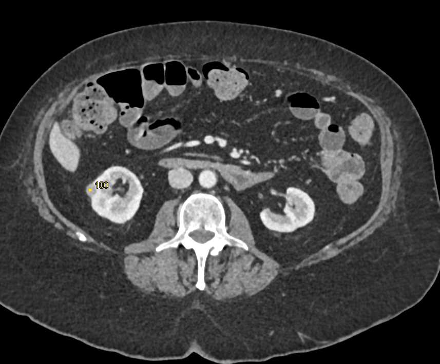 Invasive Bladder Cancer - CTisus CT Scan