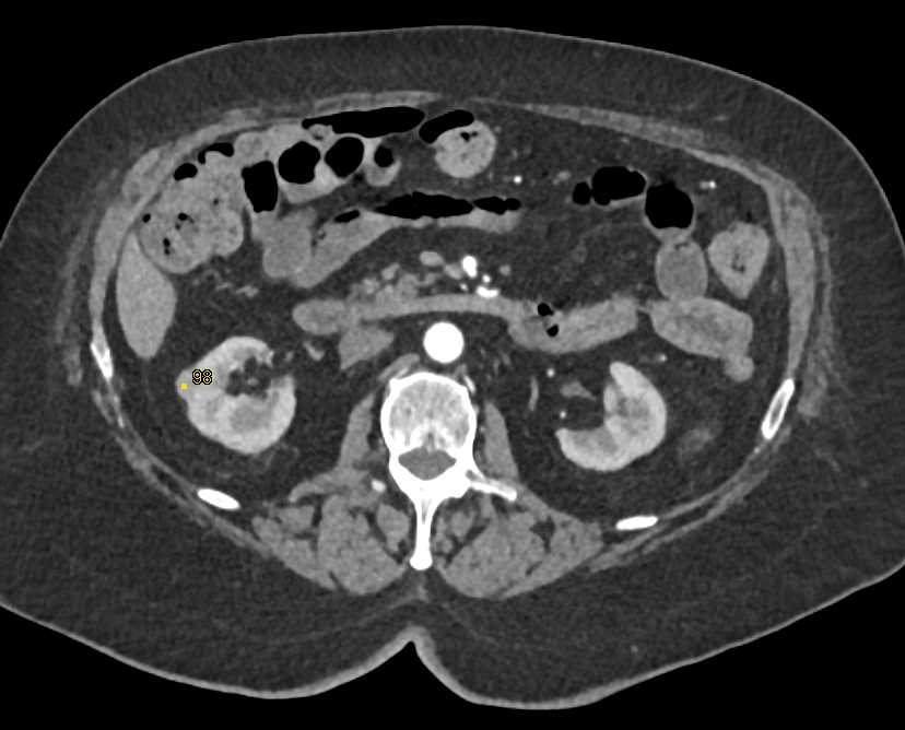 Invasive Bladder Cancer - CTisus CT Scan