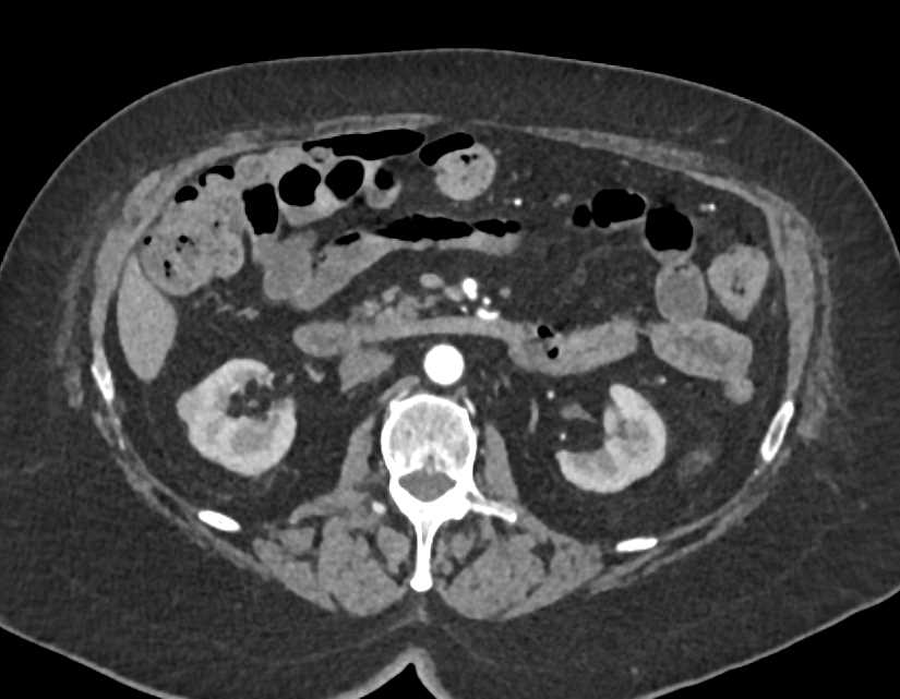 Bladder Cancer in a Patient with Unexplained Hematuria - CTisus CT Scan