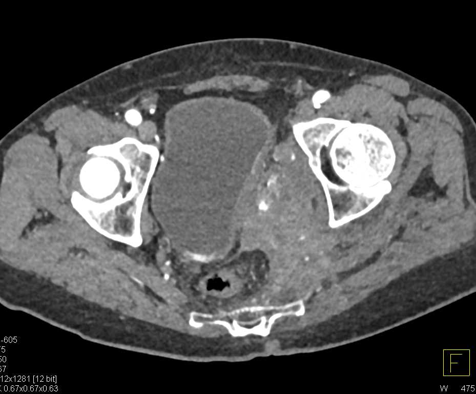 Bladder Cancer Involves the Pelvic Side Wall - CTisus CT Scan