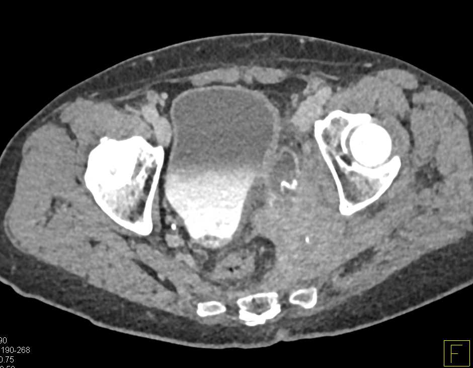 Bladder Cancer Involves the Pelvic Side Wall - CTisus CT Scan