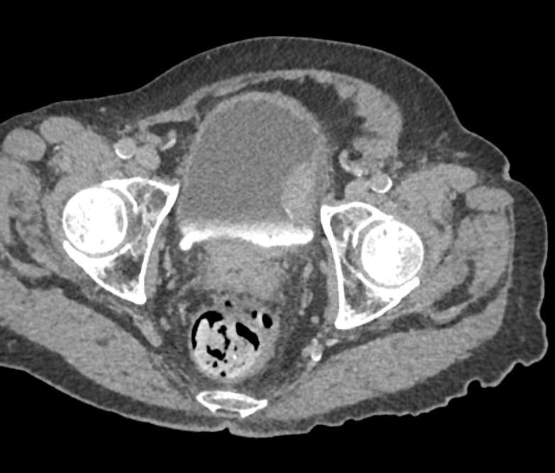 Bladder Cancer Along the Left Bladder Wall - CTisus CT Scan