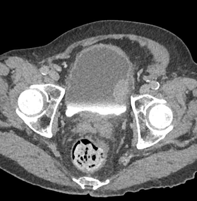 Bladder Cancer Along the Left Bladder Wall - CTisus CT Scan