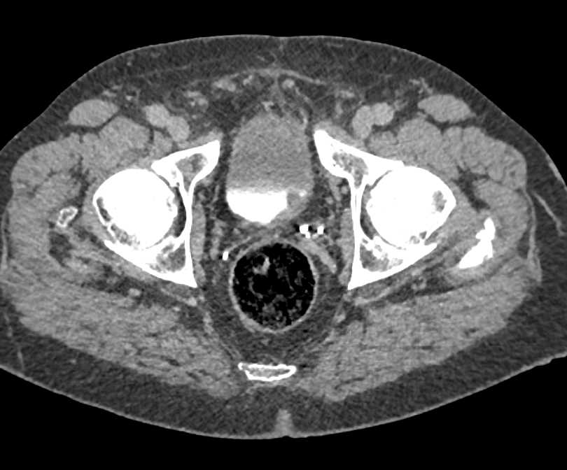 Incidental 1cm Bladder Cancer - CTisus CT Scan