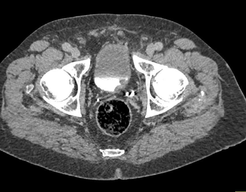 Incidental 1cm Bladder Cancer - CTisus CT Scan