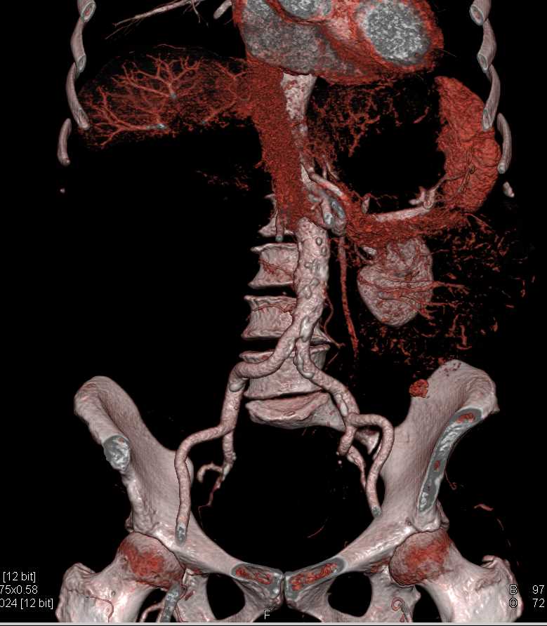 Liposarcoma Involves the Right Kidney - CTisus CT Scan