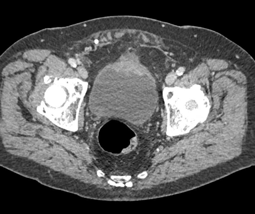 Urachal Carcinoma - CTisus CT Scan