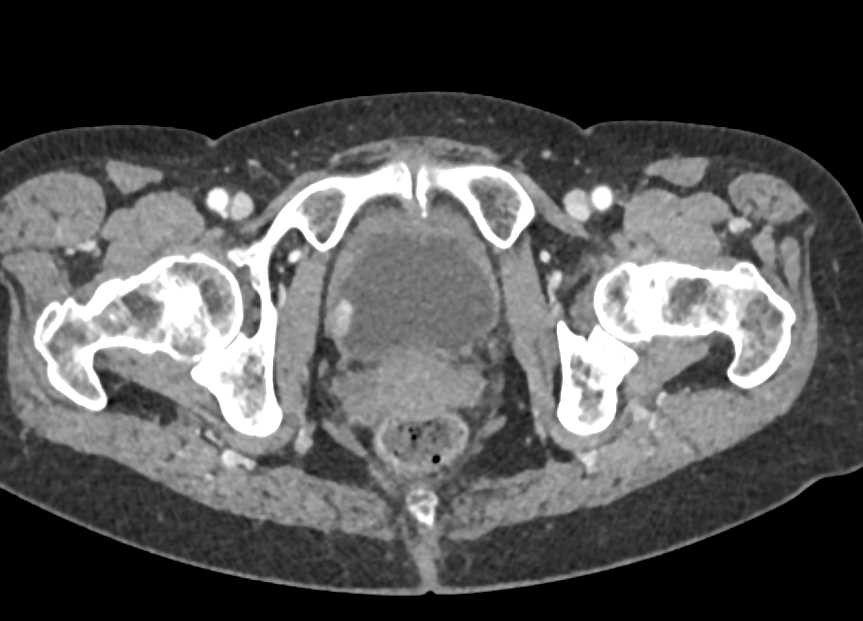 Incidental 1cm Bladder Cancer - CTisus CT Scan