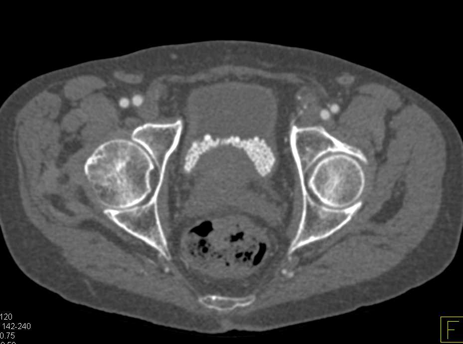 Extensive Bladder Calculi - CTisus CT Scan