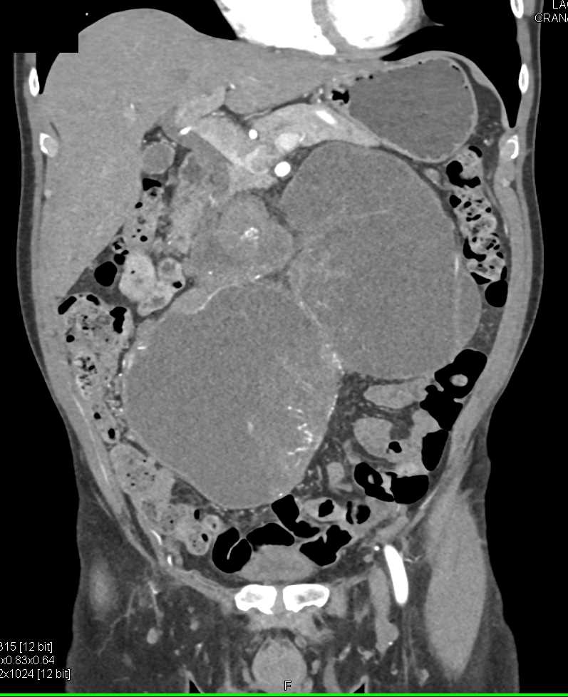 Testicular Teratoma with Large Cystic Nodes - Genitourinary Case ...