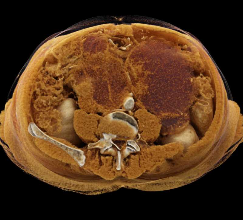 Cystic Retroperitoneal Nodes in Patient with Seminoma - CTisus CT Scan