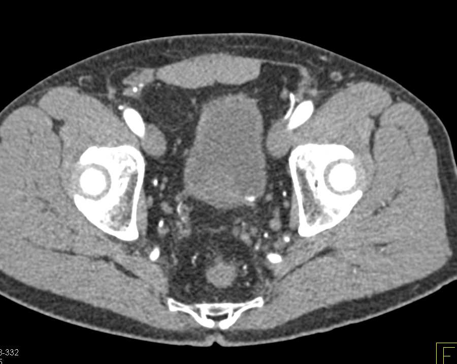 Incidental Bladder Cancer Near Left Ureterovesical Junction (UVJ) - CTisus CT Scan