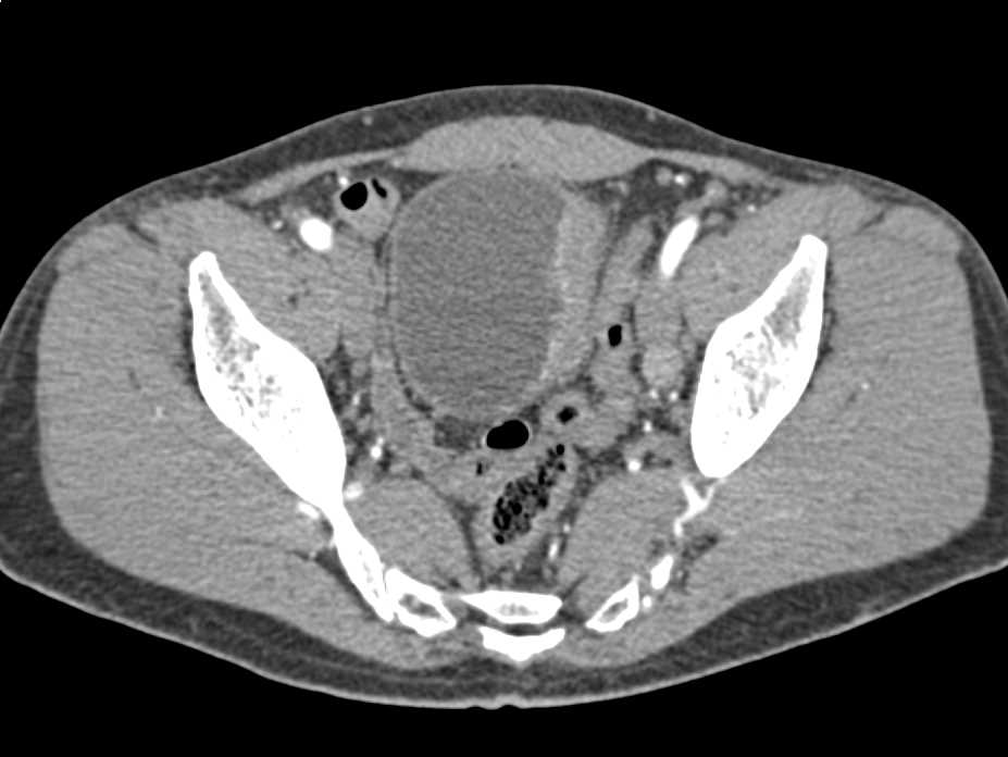 Carcinoma Left Bladder Wall - CTisus CT Scan