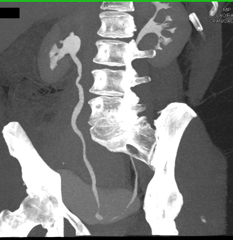 Ureteral Diverticulum - CTisus CT Scan