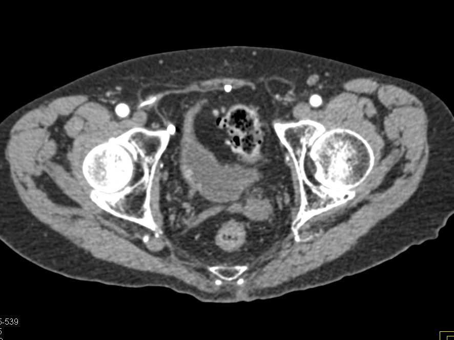 Bladder Cancer Right Bladder Wall - CTisus CT Scan