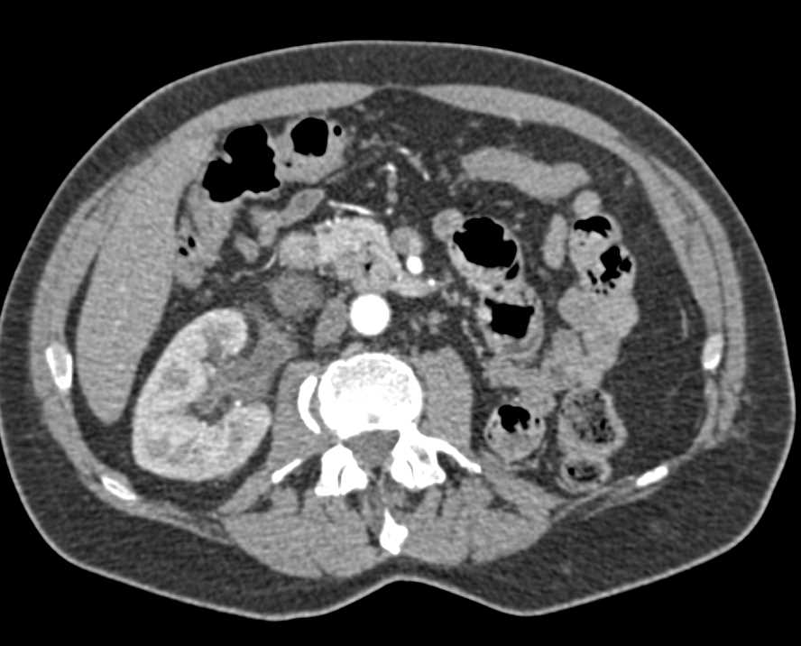 Bladder Cancer with Involvement of the Distal Right Ureter - CTisus CT Scan