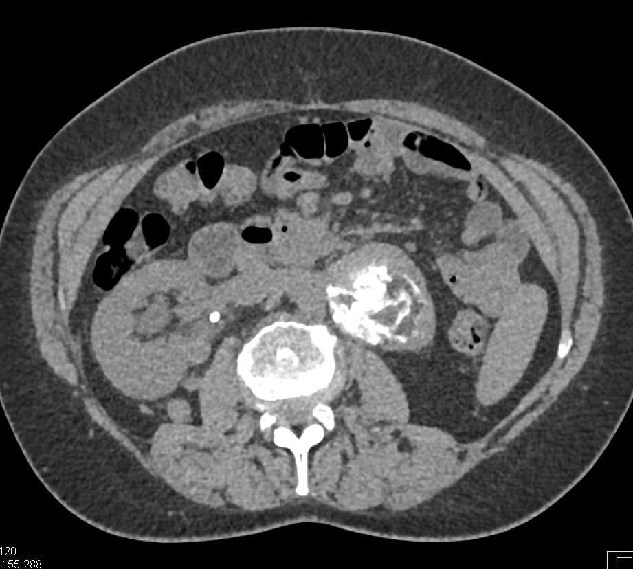 Calcified Lymph Nodes - CTisus CT Scan