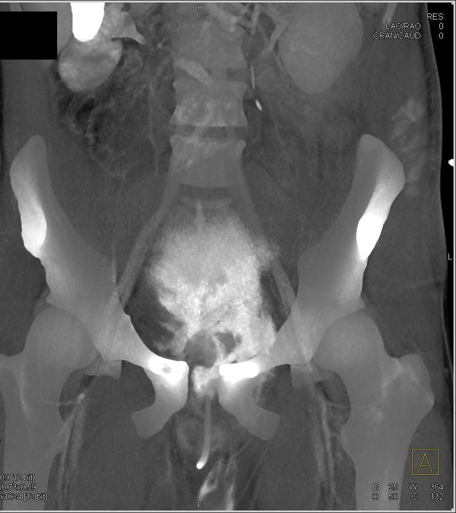 Extraperitoneal Leak from the Bladder - CTisus CT Scan