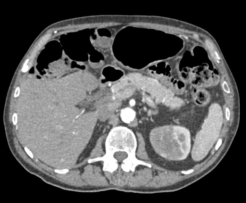 Transitional Cell Carcinoma Bladder and the Left Kidney - CTisus CT Scan