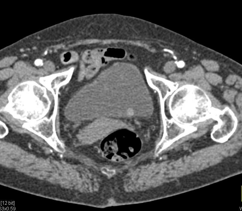 Multifocal Bladder Cancers - CTisus CT Scan