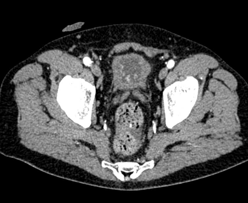 CTisus CT Scanning | Multifocal Bladder Cancer