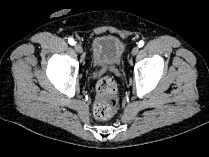 Multifocal Bladder Cancer - CTisus CT Scan