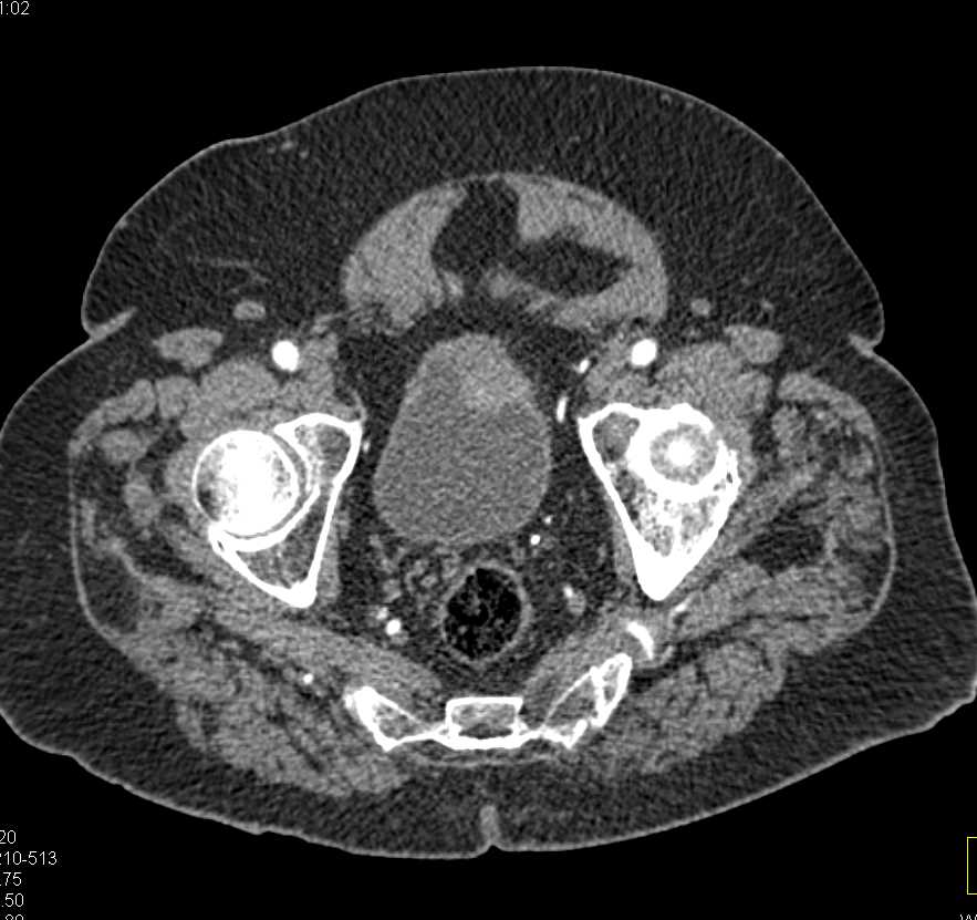 Bladder cancer - CTisus CT Scan