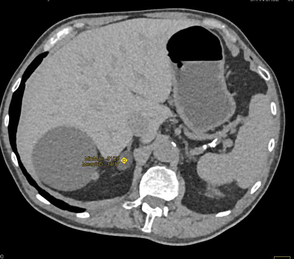 Adrenal, Renal and Liver Cysts - CTisus CT Scan