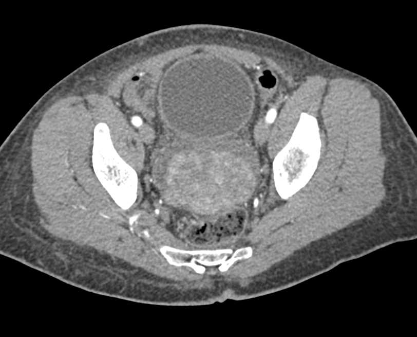 Prostate Sarcoma - CTisus CT Scan