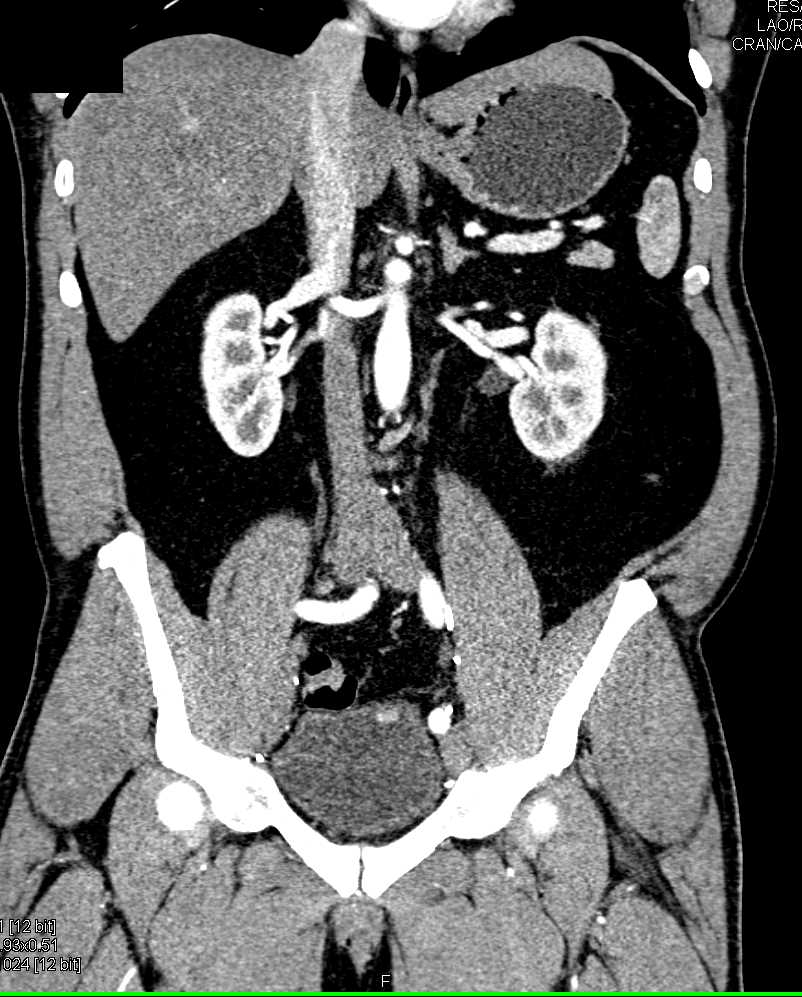 Post Pelvic Nodal Dissection - CTisus CT Scan