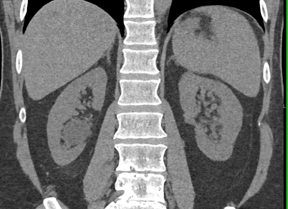 Transitional Cell Carcinoma Distal Left Renal Ureter - CTisus CT Scan