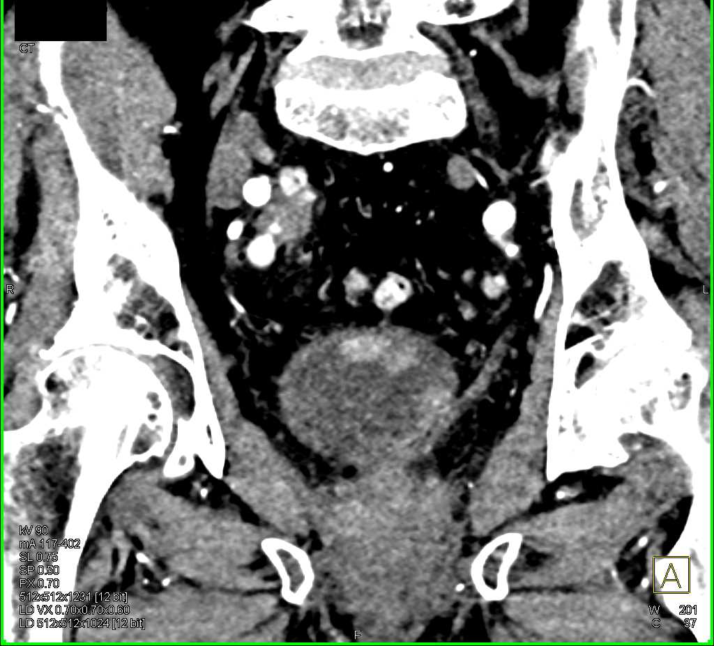 Multifocal Bladder Cancer - CTisus CT Scan