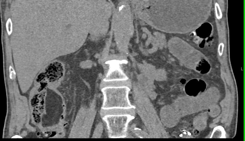 Bladder Cancer Obstructs the Left Ureter - CTisus CT Scan