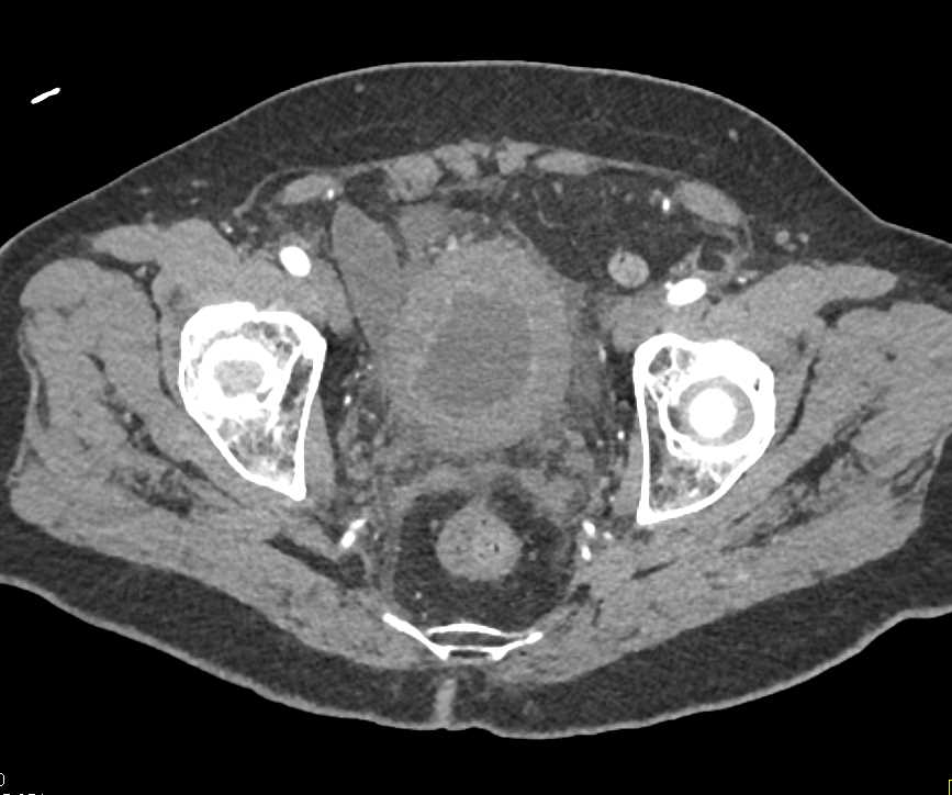 CTisus CT Scanning | Cystitis with Thick Walled Bladder