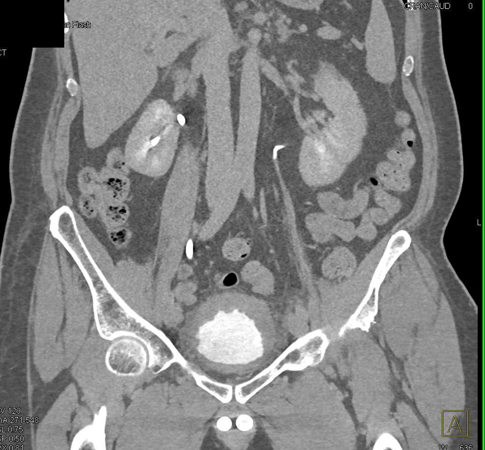 Cystitis with Thick Walled Bladder - CTisus CT Scan
