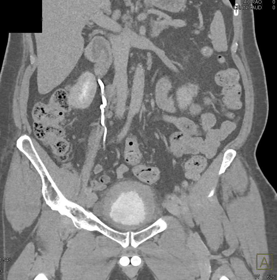 Cystitis with Thick Walled Bladder - CTisus CT Scan