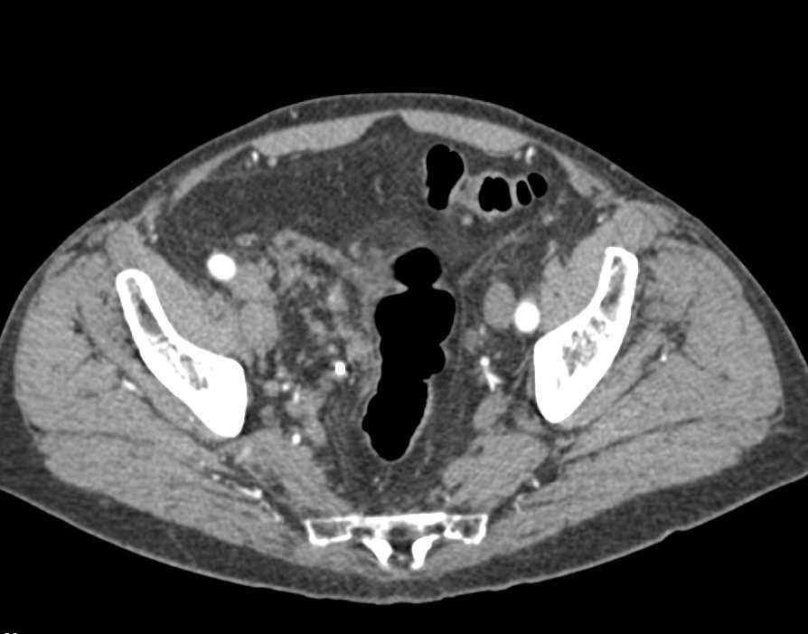 Bladder Cancer Arises Near a Bladder Diverticulum - CTisus CT Scan