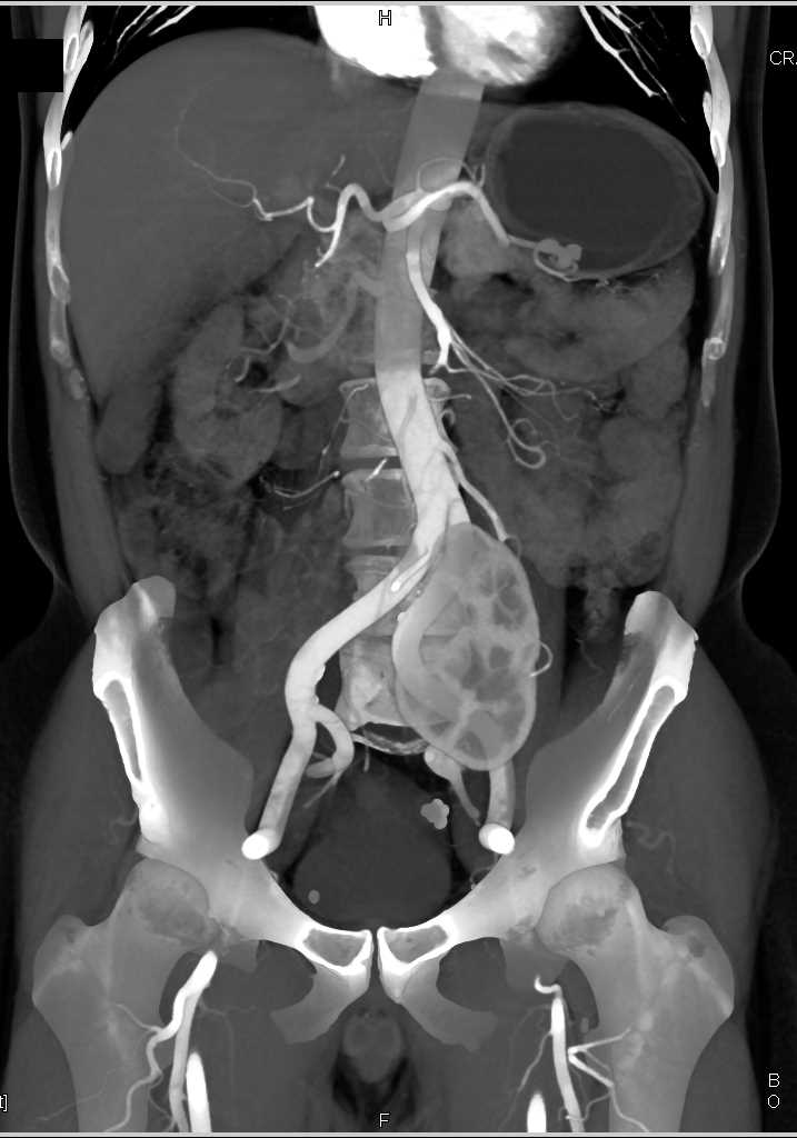 Multiple Calculi Distal Left Ureter - CTisus CT Scan
