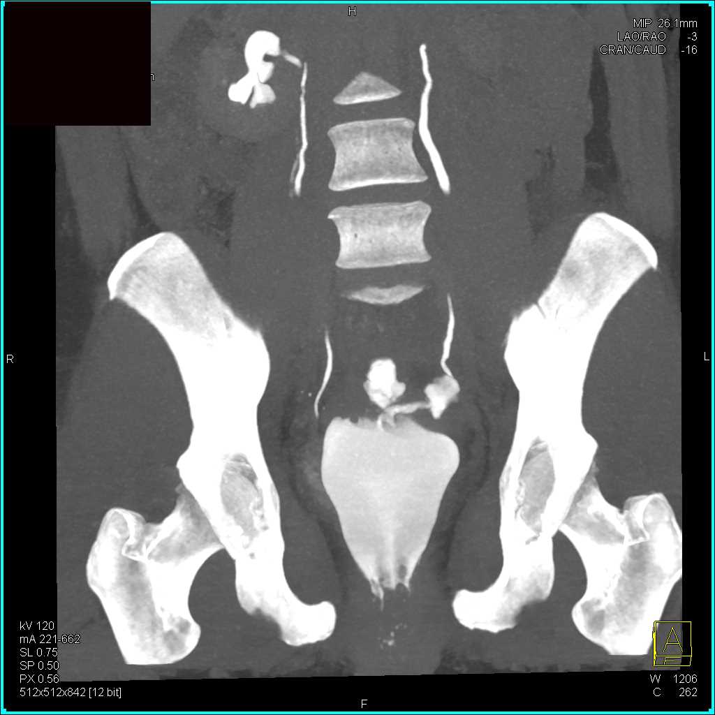 Fistulae from Bladder to Cervix on a CT Cystogram - CTisus CT Scan