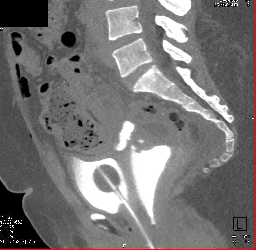 Fistulae from Bladder to Cervix on a CT Cystogram - CTisus CT Scan