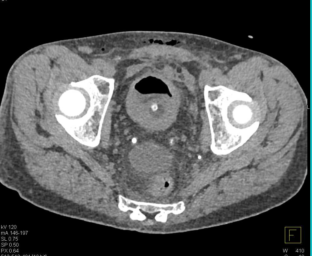 Leak from Urethra Post Prostatectomy with CT Cystogram - CTisus CT Scan