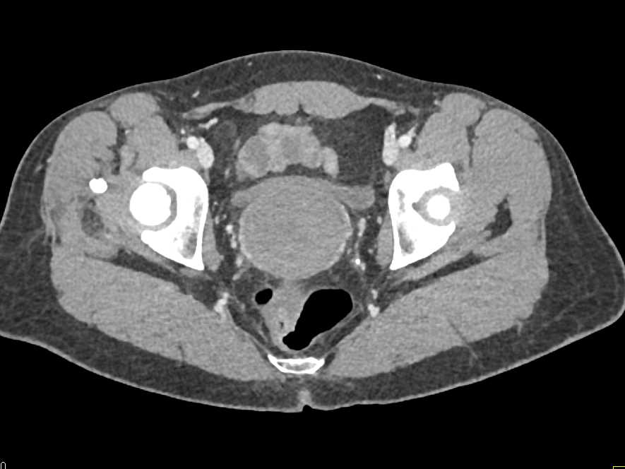 Enlarged Prostate Gland - CTisus CT Scan