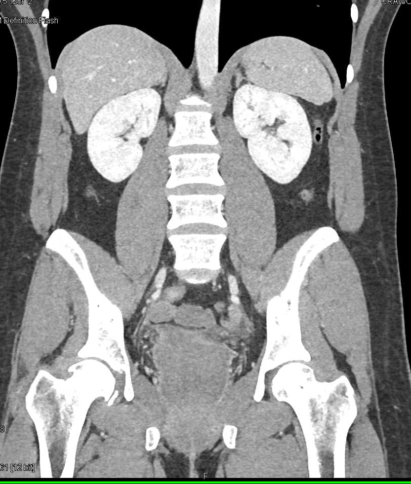 Enlarged Prostate Gland - CTisus CT Scan