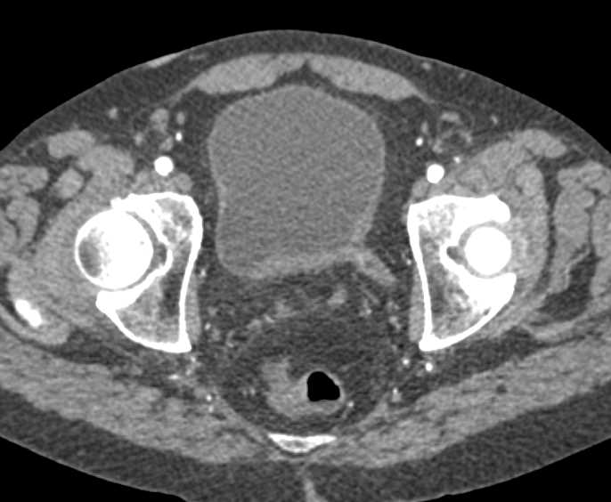 Bladder Cancer - CTisus CT Scan