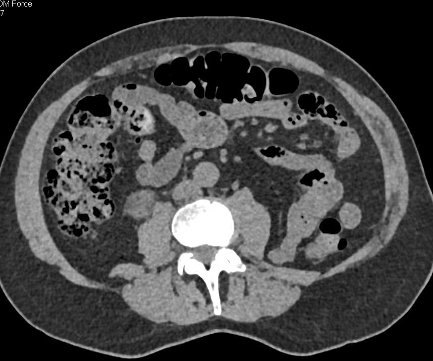 Dilated Right Ureter - CTisus CT Scan