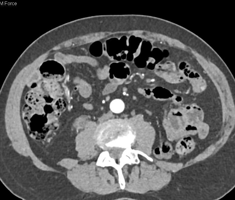 Dilated Right Ureter - CTisus CT Scan