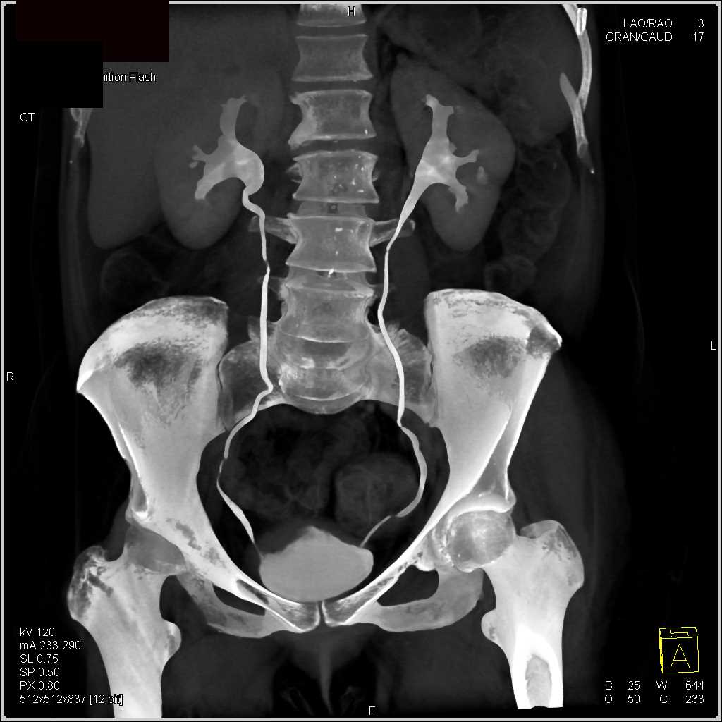 Bladder cancer - CTisus CT Scan